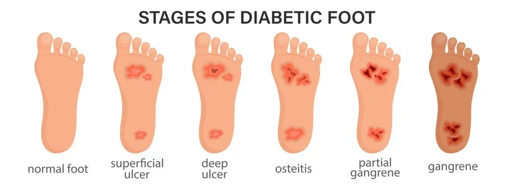 Five stages of diabetic foot ulcer progression from pre-ulcer to extensive gangrene