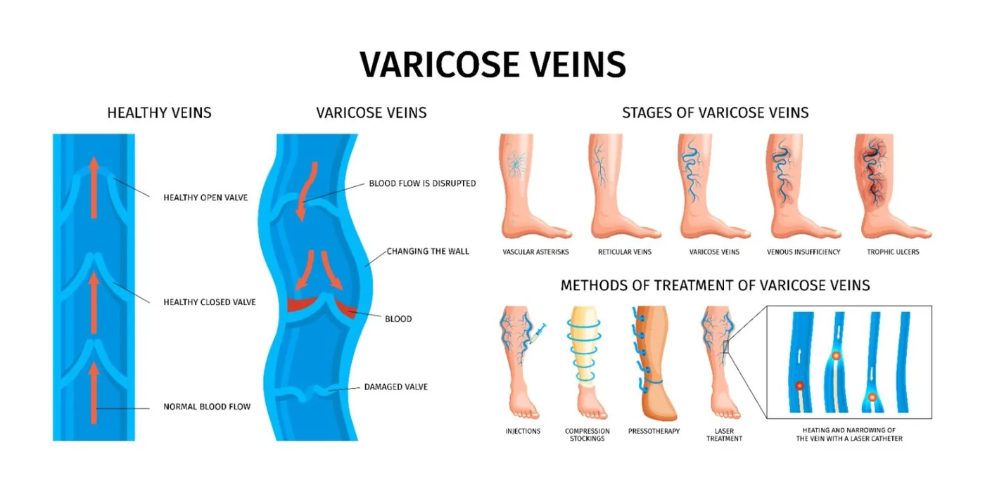 Modern endovenous laser treatment for varicose veins minimally invasive and same-day discharge