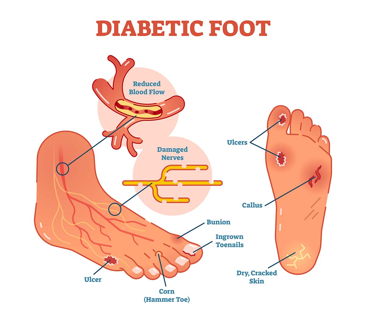 diabetic foot ulcer