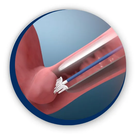 papsmear