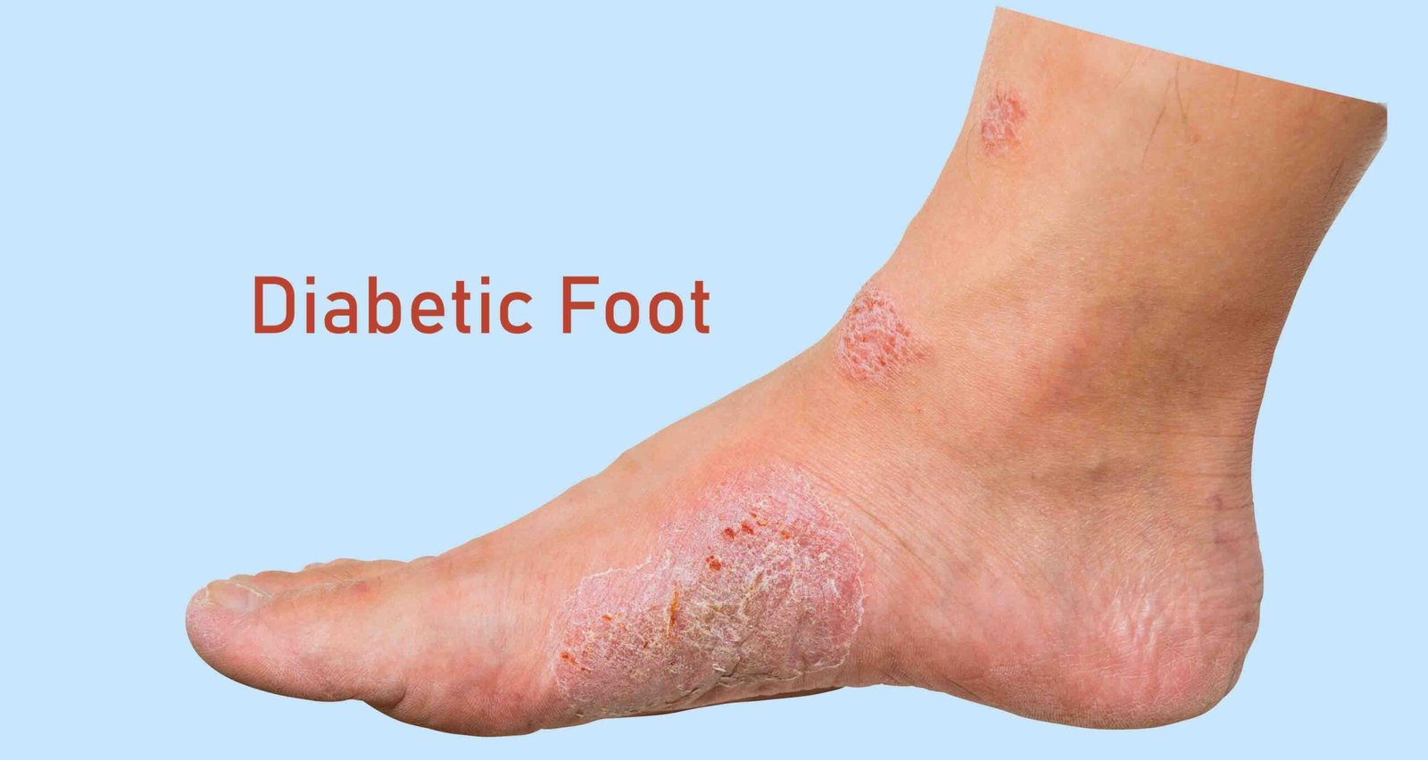 Wounds and dry skin on human foot. Ulcers and infection of medical concepts.