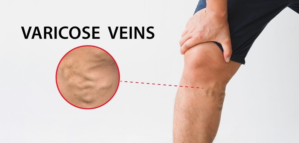 varicose veins laser treatment in mumbai